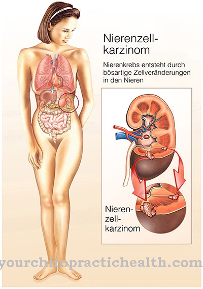 Karcinom ledvin