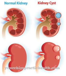 Kidney cyst (cyst kidneys)