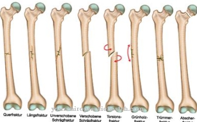 Femur fracture