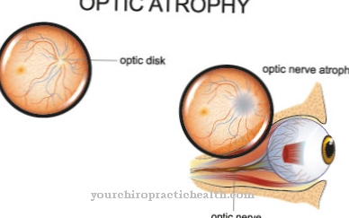 Optiline atroofia