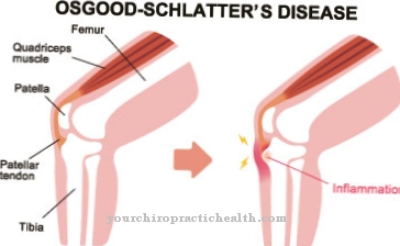 Osgood Schlatter