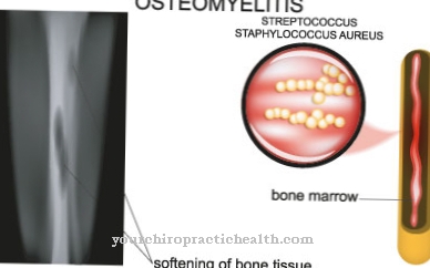 Osteomielitas (kaulų čiulpų uždegimas)