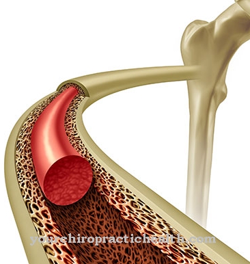 Osteomyelofibrosis