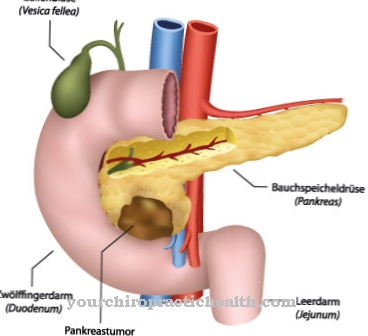 Tumor pancreático