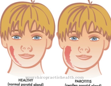 Parotitis