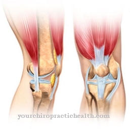 Patellar fracture