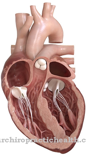 Pericardial effusion