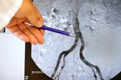 Perifeersete arterite haigus