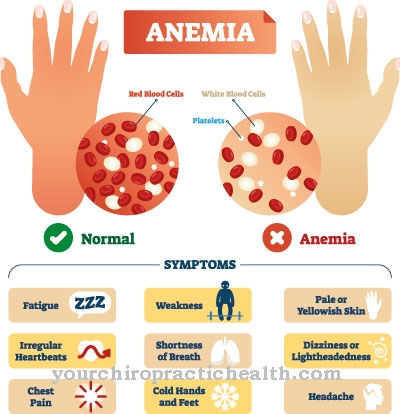 Pernicious anemia