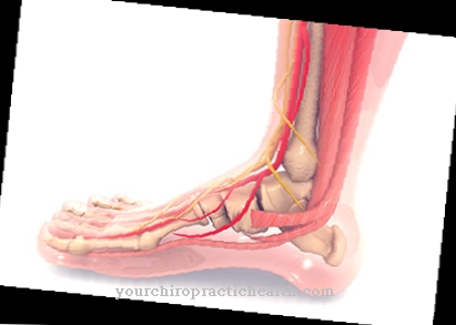 Peroneal paralysis