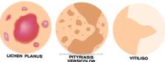 Pityriasis versicolor (грибок висівок)