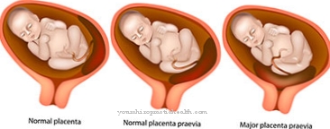 Placenta previa