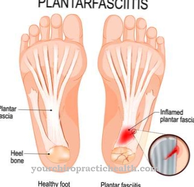 Plantaire fasciitis