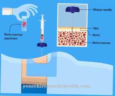 Plasmacytoma (multiple myeloma)