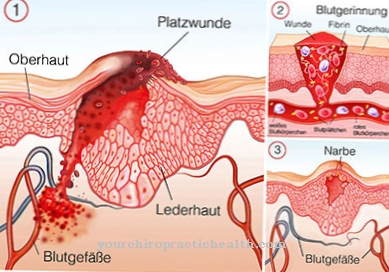 Laceration