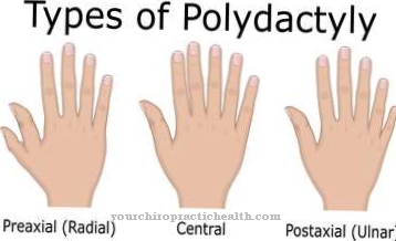 polydaktýlia