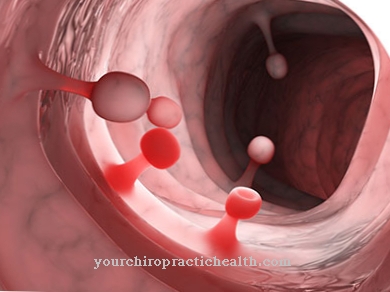 Polyps (swelling)