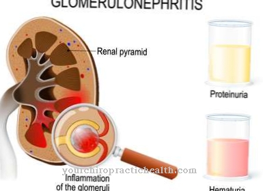 glomerulonephritis หลังการติดเชื้อ