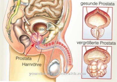 Prostate enlargement