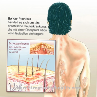 Psoriatic arthritis