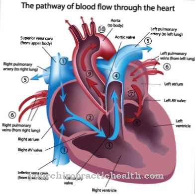 Pulmonary stenosis