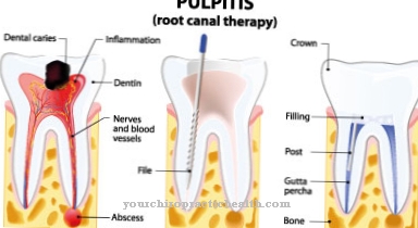 Pulpitis