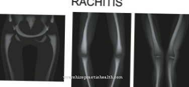 rahīts