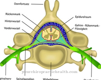 Spinal cord infarction