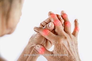 Reactive arthritis