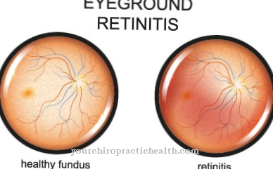 Retinīts