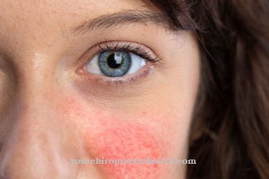 Rosacea (bệnh trứng cá đỏ)