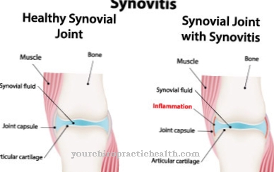 SAPHO syndrome