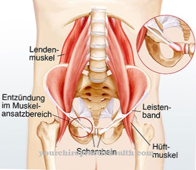 Pubic bone inflammation