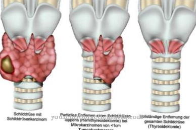 Thyroid cancer