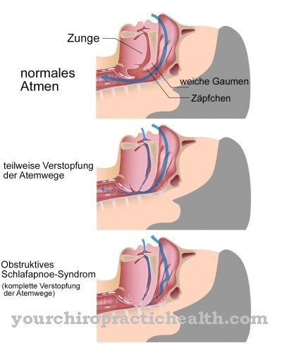 Chứng ngưng thở lúc ngủ