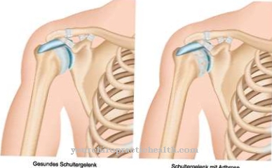 Osteoartritis ramena (omartroza)