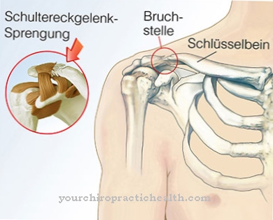 Shoulder joint dislocation