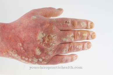 psoriasis