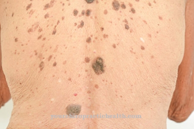 Seborrheic keratosis