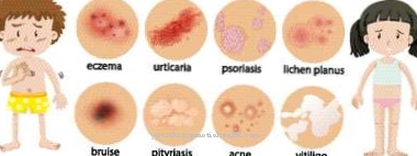 กลาก Seborrheic