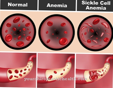 Anemia celulelor secera