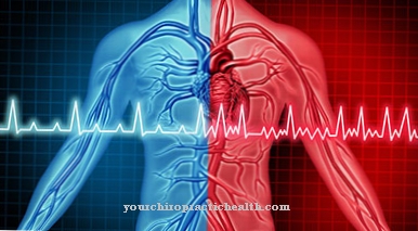 Sick sinus syndrome