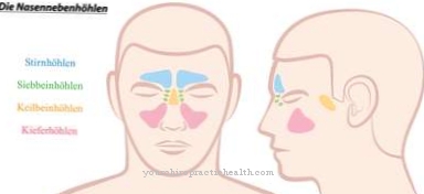 Frontal sinusitis