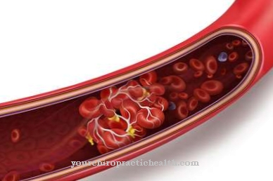 Sinus thrombosis