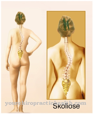 scoliosis