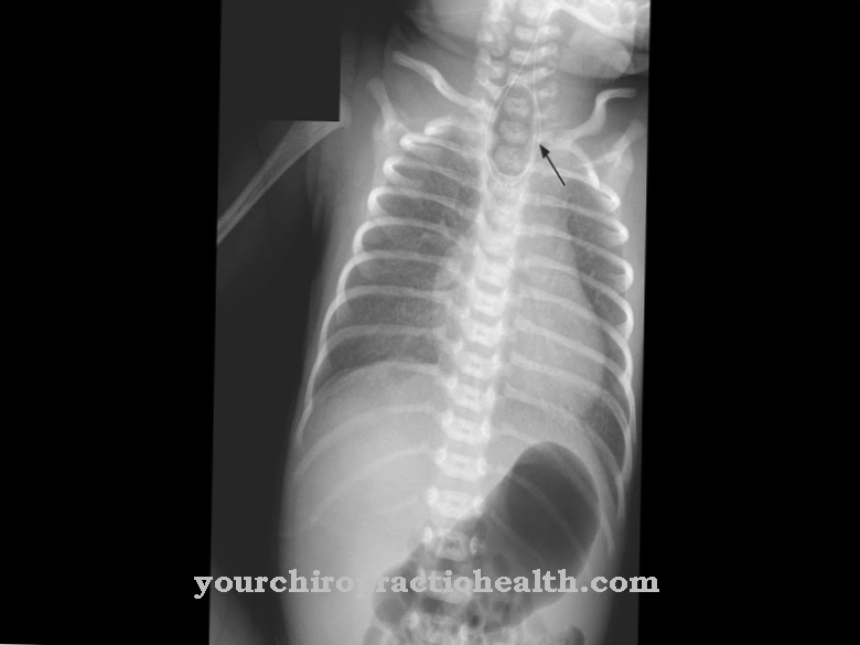 Esophageal atresia