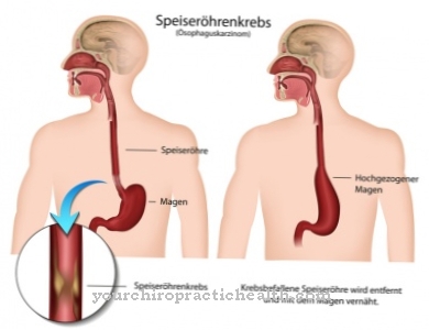 Esophageal cancer