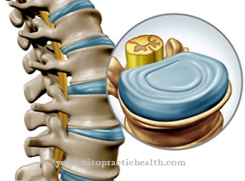 Spondylodiscite