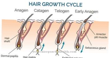 Capelli pesanti (irsutismo)