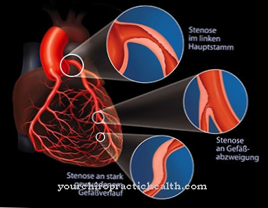 Stenosis